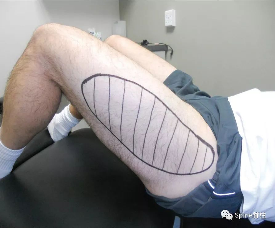 大腿外侧感觉异常、疼痛，需警惕“紧身裤综合征”！