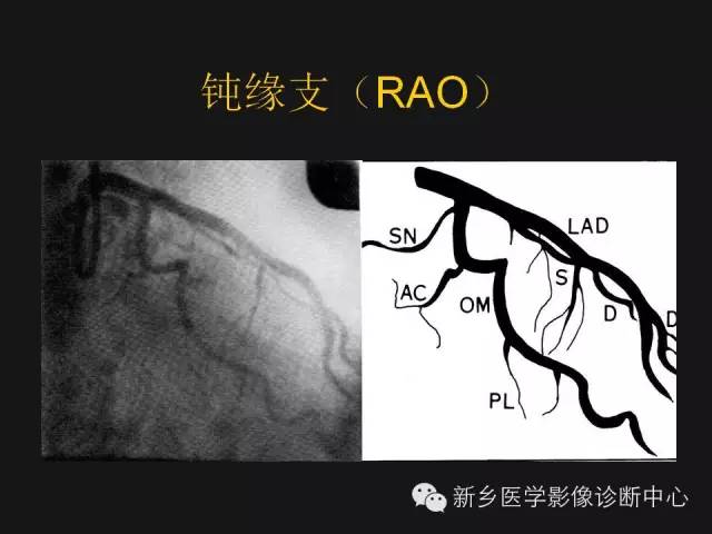 冠状动脉解剖影像，这篇讲的真齐全！