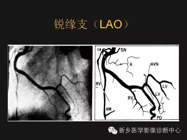 冠状动脉解剖影像，这篇讲的真齐全！