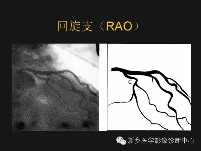 冠状动脉解剖影像，这篇讲的真齐全！