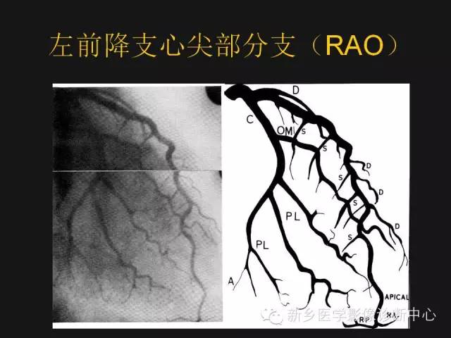 冠状动脉解剖影像，这篇讲的真齐全！