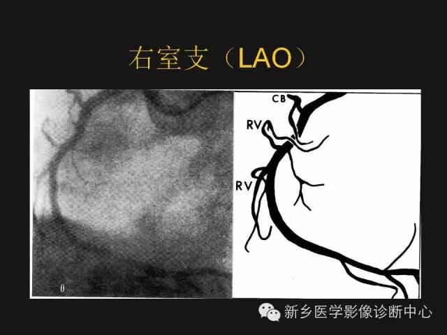 冠状动脉解剖影像，这篇讲的真齐全！