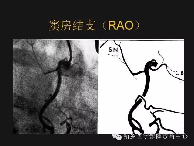 冠状动脉解剖影像，这篇讲的真齐全！