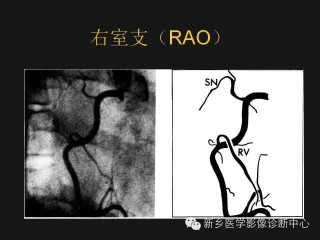 冠状动脉解剖影像，这篇讲的真齐全！