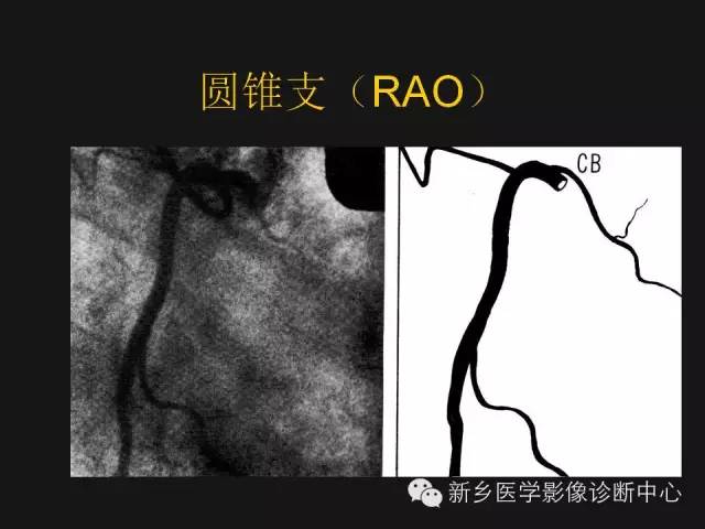 冠状动脉解剖影像，这篇讲的真齐全！