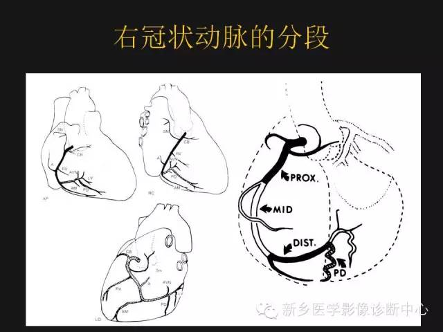 冠状动脉解剖影像，这篇讲的真齐全！