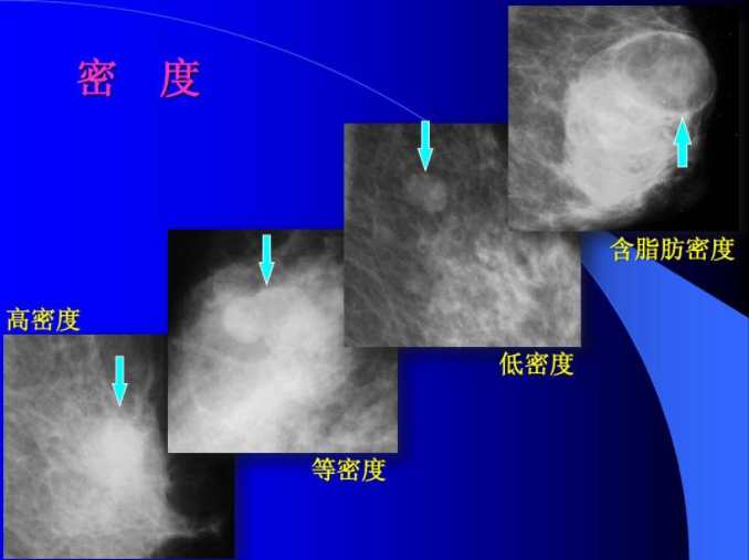 乳腺X线摄影密度表型与患乳腺癌的风险，研究有哪些要点？