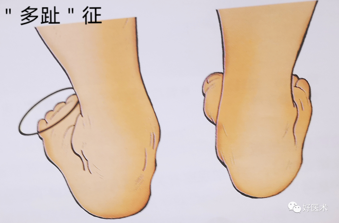 临床必备：足与踝关节体格检查，本文帮你全面掌握！