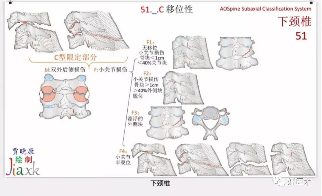 收藏版：636张AO骨折分型高清彩色图谱，比教科书更清晰！