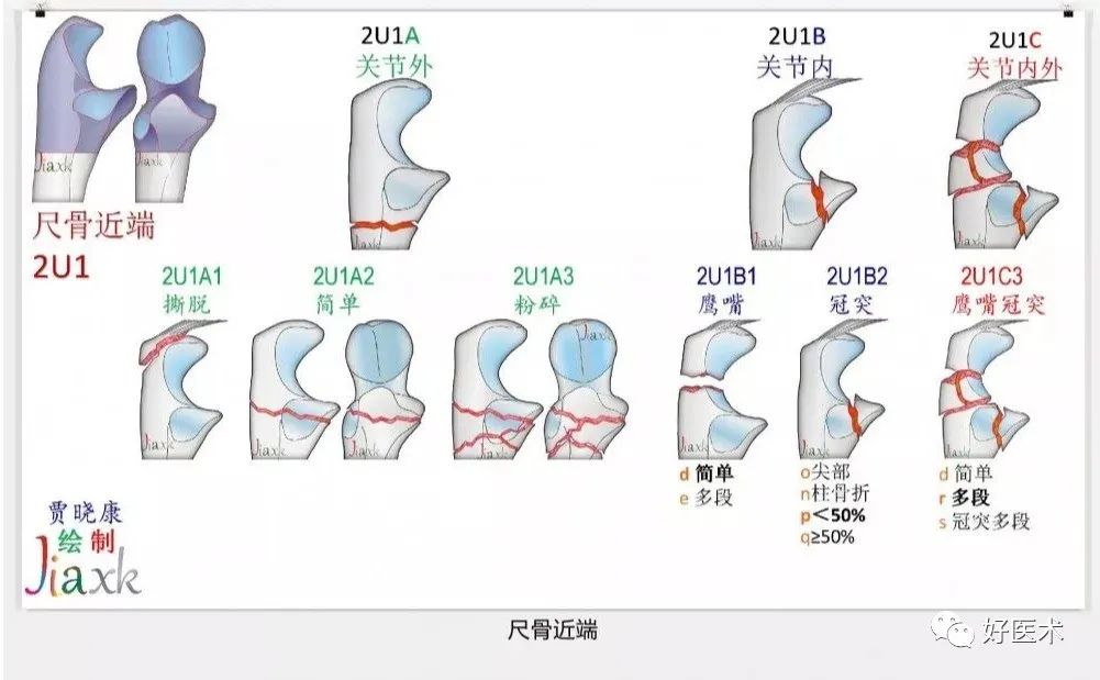 收藏版：636张AO骨折分型高清彩色图谱，比教科书更清晰！