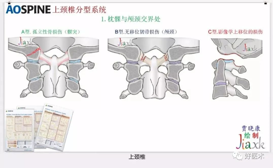 收藏版：636张AO骨折分型高清彩色图谱，比教科书更清晰！