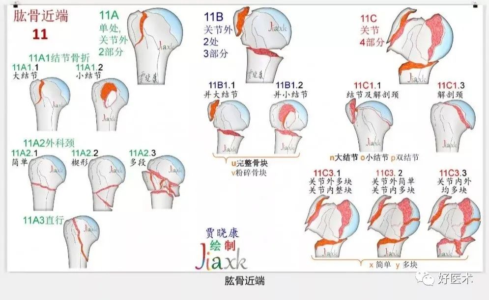 收藏版：636张AO骨折分型高清彩色图谱，比教科书更清晰！