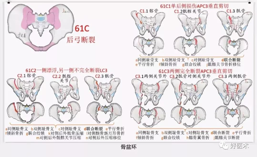 收藏版：636张AO骨折分型高清彩色图谱，比教科书更清晰！