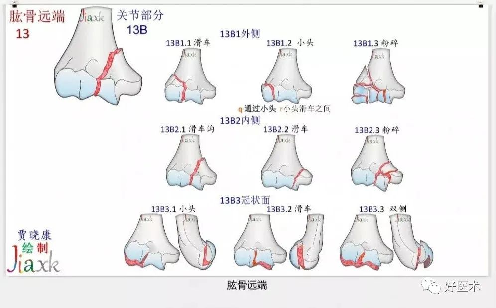 收藏版：636张AO骨折分型高清彩色图谱，比教科书更清晰！