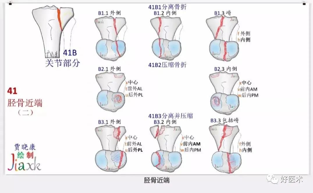 收藏版：636张AO骨折分型高清彩色图谱，比教科书更清晰！