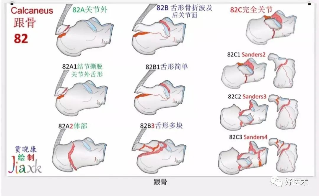 收藏版：636张AO骨折分型高清彩色图谱，比教科书更清晰！