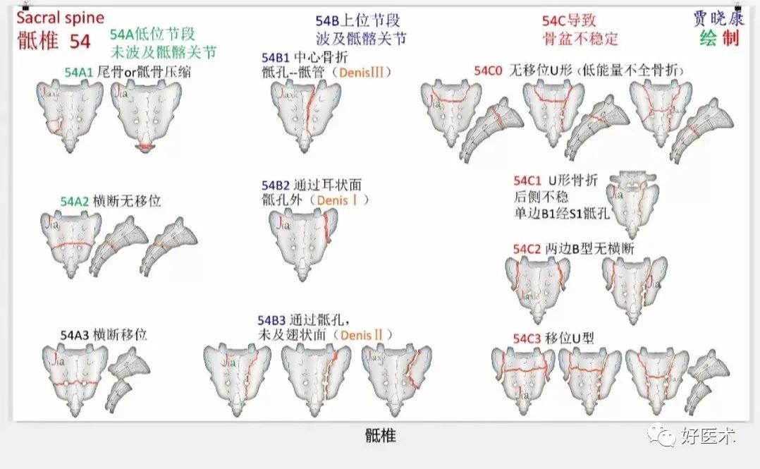 收藏版：636张AO骨折分型高清彩色图谱，比教科书更清晰！