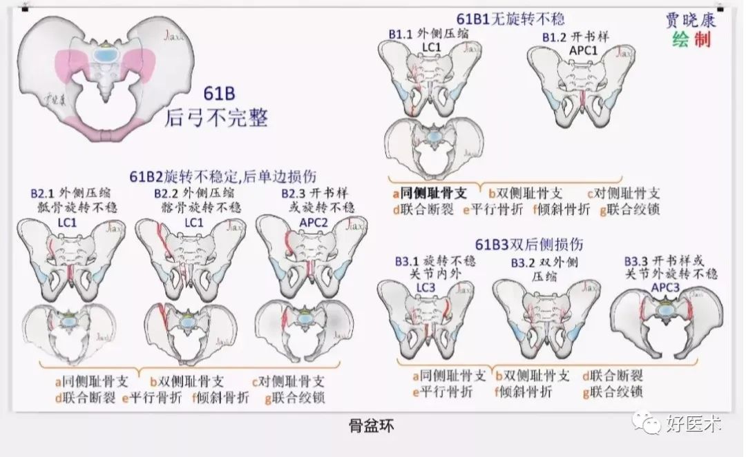 收藏版：636张AO骨折分型高清彩色图谱，比教科书更清晰！