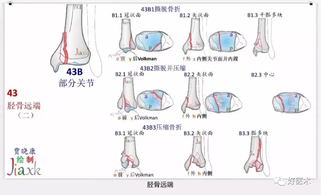 收藏版：636张AO骨折分型高清彩色图谱，比教科书更清晰！