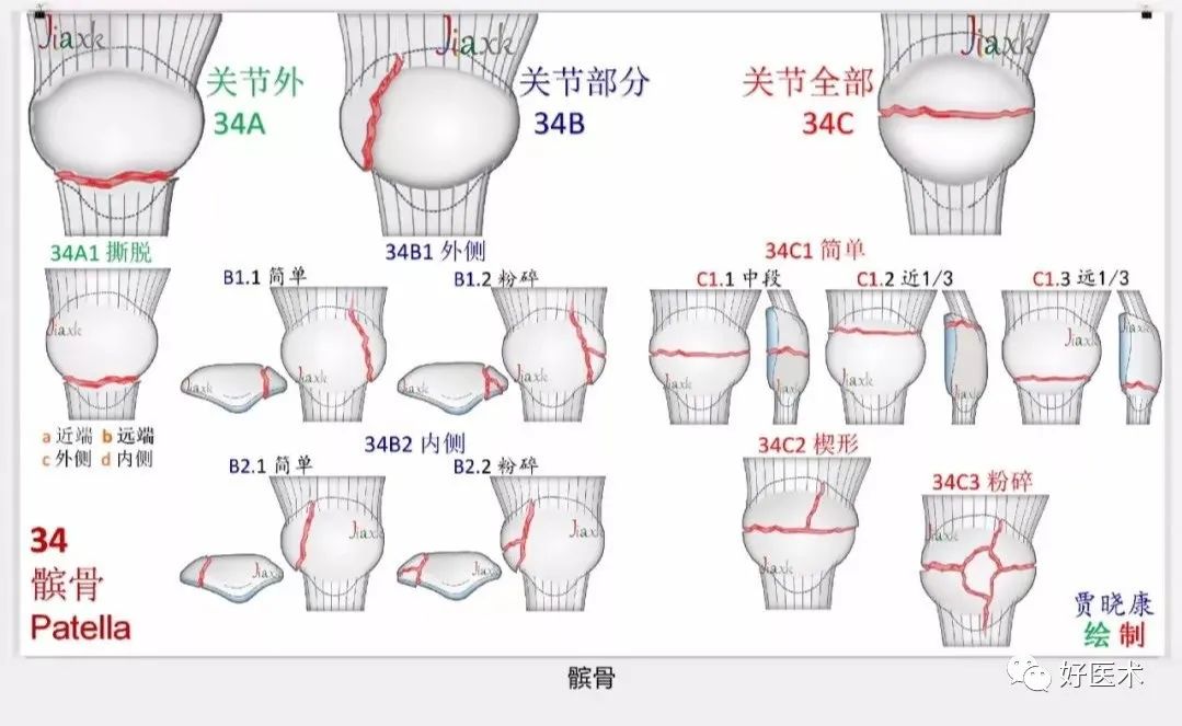 收藏版：636张AO骨折分型高清彩色图谱，比教科书更清晰！