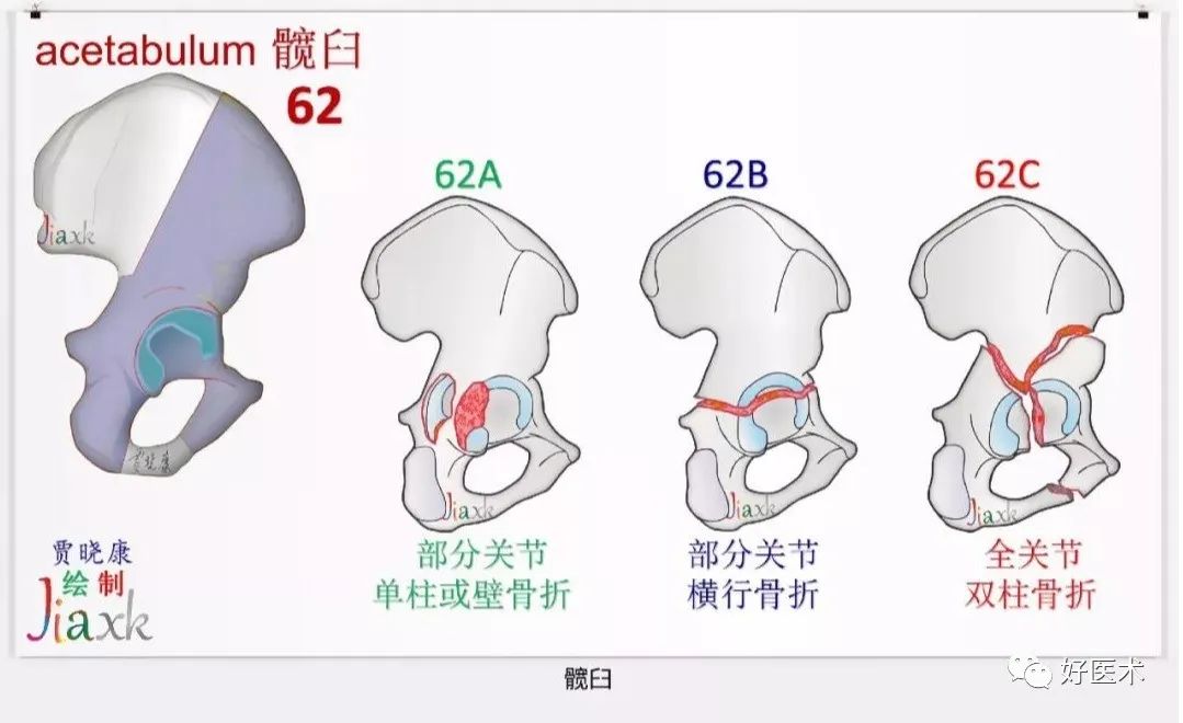 收藏版：636张AO骨折分型高清彩色图谱，比教科书更清晰！