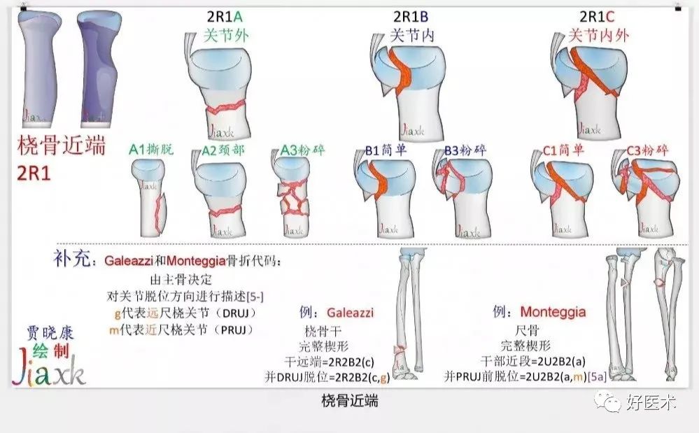 收藏版：636张AO骨折分型高清彩色图谱，比教科书更清晰！