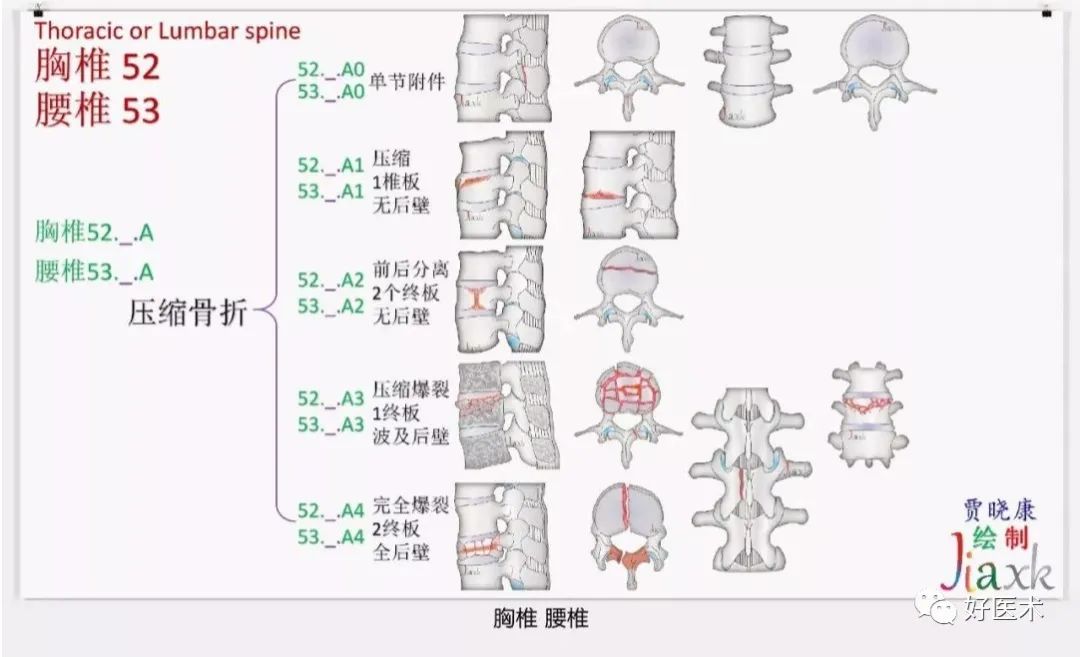 收藏版：636张AO骨折分型高清彩色图谱，比教科书更清晰！