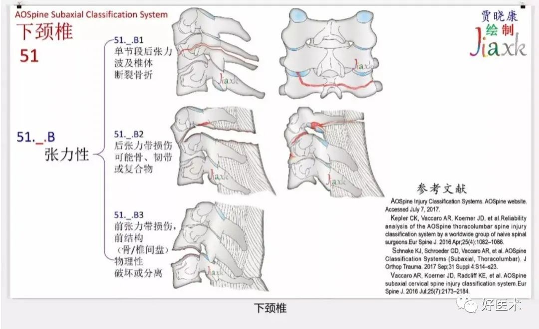 收藏版：636张AO骨折分型高清彩色图谱，比教科书更清晰！