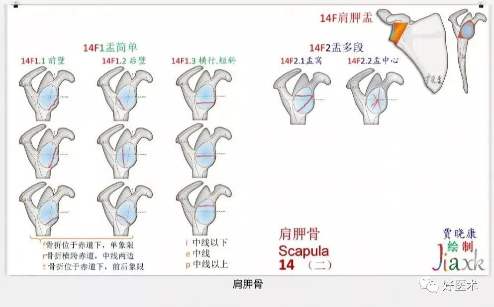 收藏版：636张AO骨折分型高清彩色图谱，比教科书更清晰！