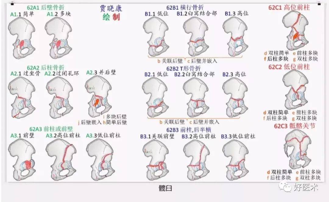 收藏版：636张AO骨折分型高清彩色图谱，比教科书更清晰！