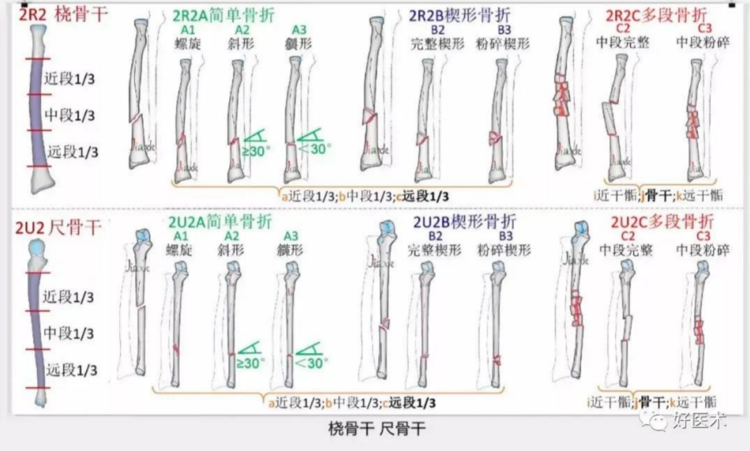 收藏版：636张AO骨折分型高清彩色图谱，比教科书更清晰！