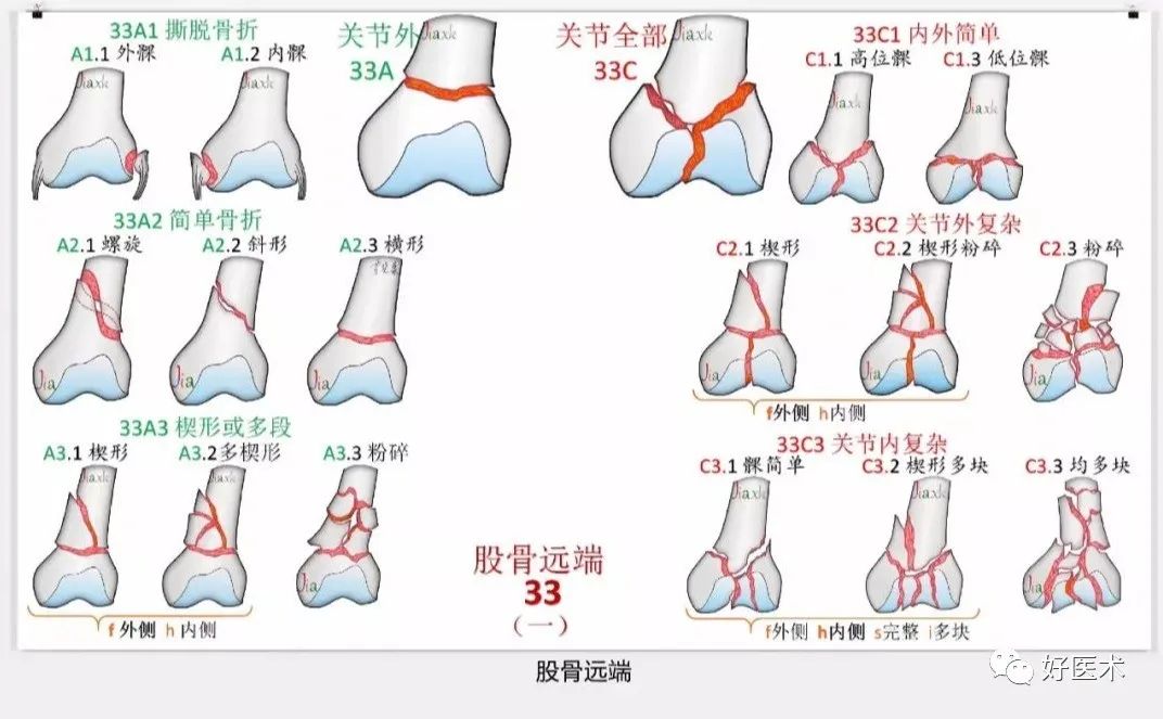 收藏版：636张AO骨折分型高清彩色图谱，比教科书更清晰！