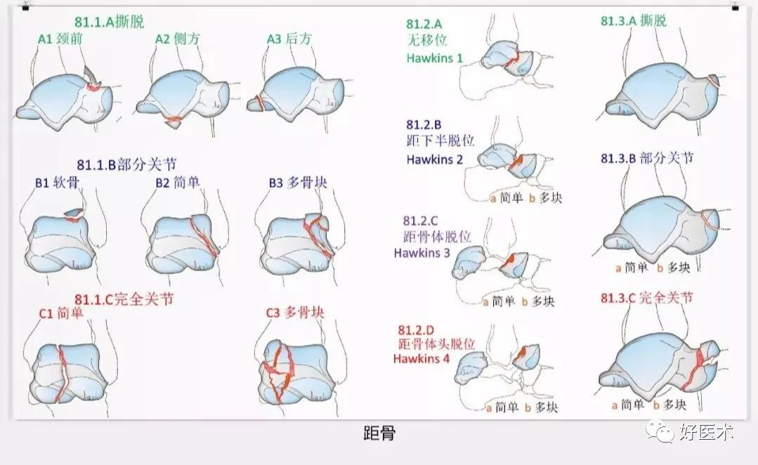 收藏版：636张AO骨折分型高清彩色图谱，比教科书更清晰！