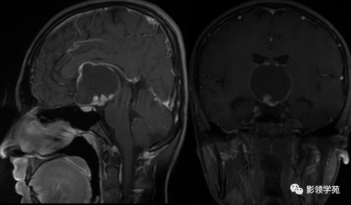 ​鞍区常见肿瘤的影像鉴别诊断，快收藏起来！