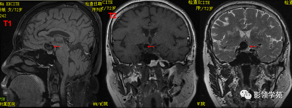 ​鞍区常见肿瘤的影像鉴别诊断，快收藏起来！