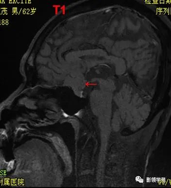 ​鞍区常见肿瘤的影像鉴别诊断，快收藏起来！