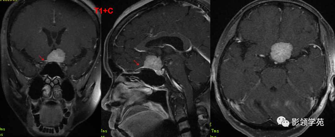​鞍区常见肿瘤的影像鉴别诊断，快收藏起来！