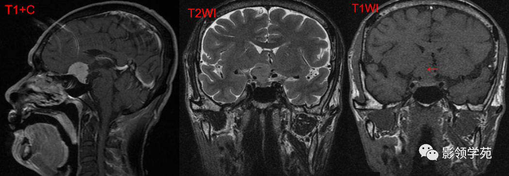 ​鞍区常见肿瘤的影像鉴别诊断，快收藏起来！