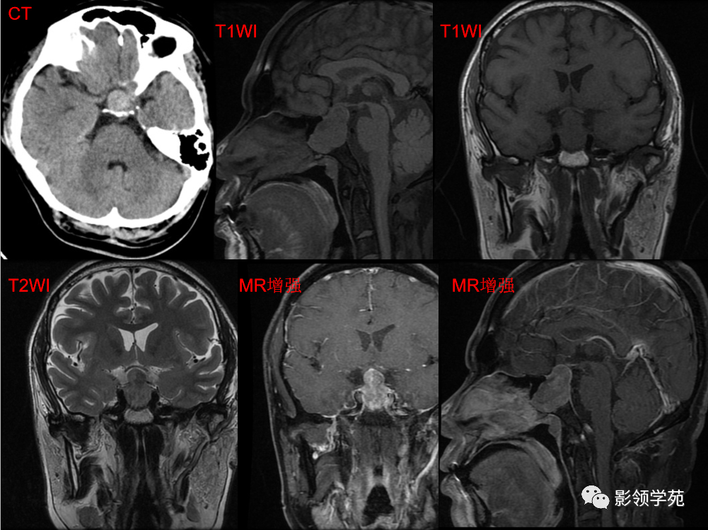 ​鞍区常见肿瘤的影像鉴别诊断，快收藏起来！