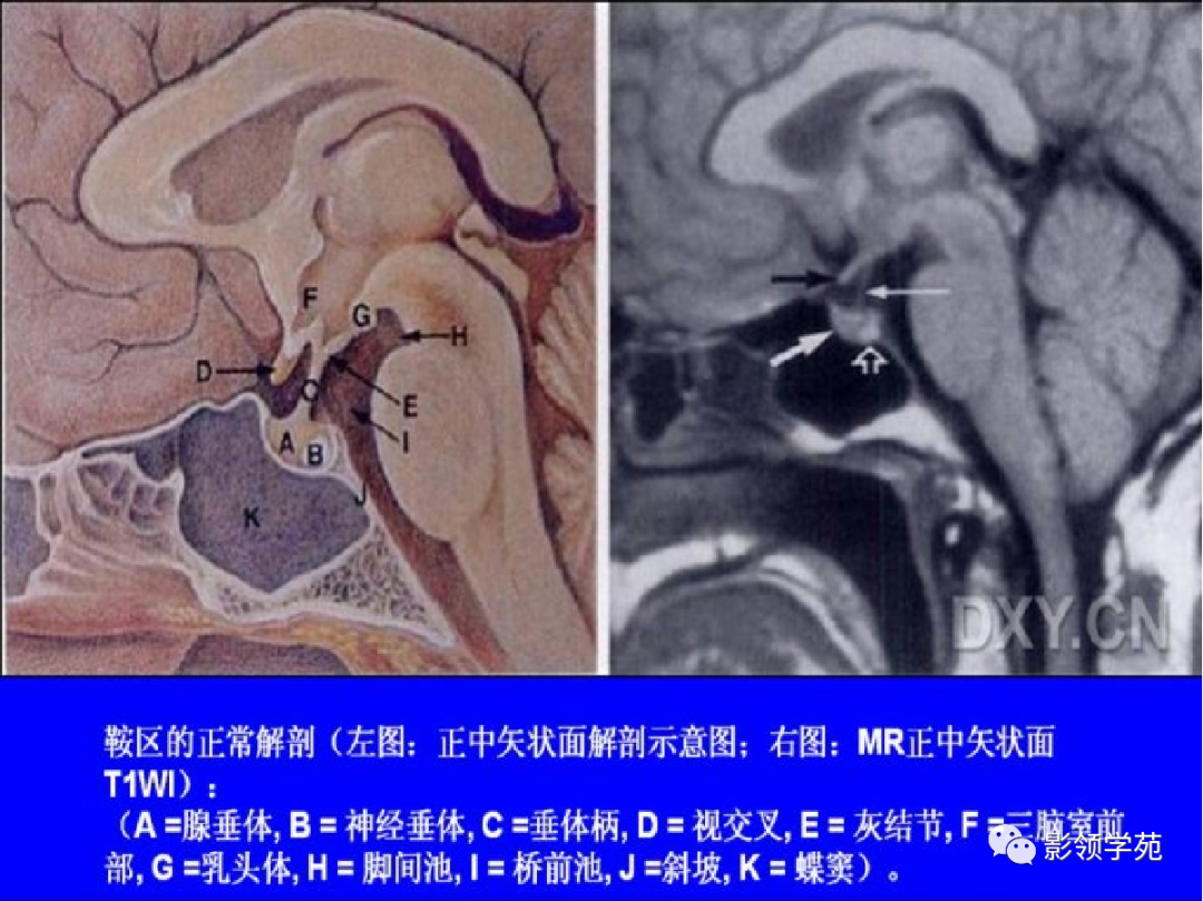 ​鞍区常见肿瘤的影像鉴别诊断，快收藏起来！