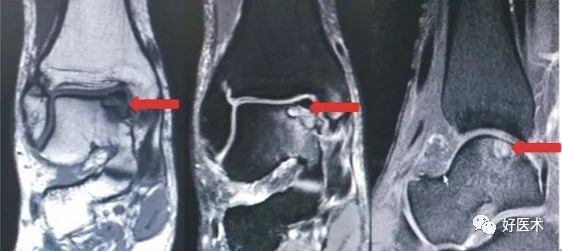 这种踝关节损伤并不简单，尽早诊断、治疗对改善预后至关重要！