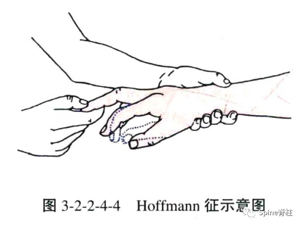 hoffmann征图片
