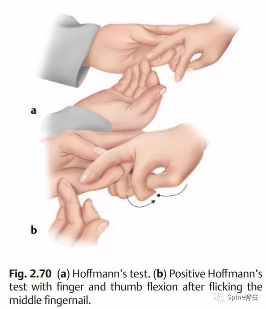 霍夫曼征颈椎病图片