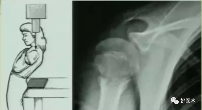 肱骨近端骨折：从分型、诊断、治疗到术后康复，全面讲解！
