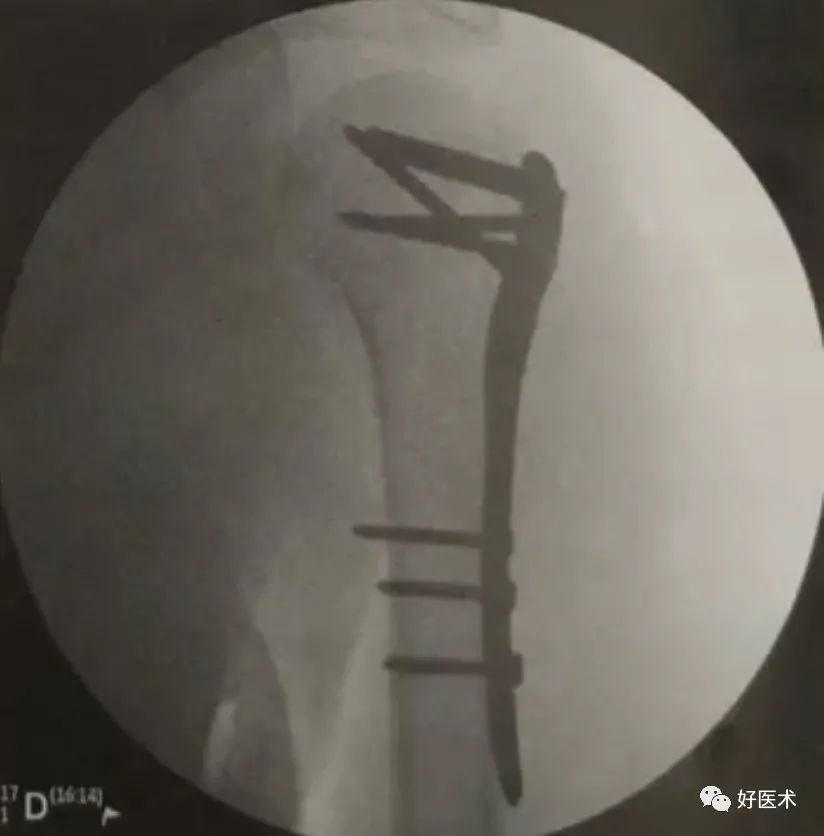 肱骨近端骨折：从分型、诊断、治疗到术后康复，全面讲解！