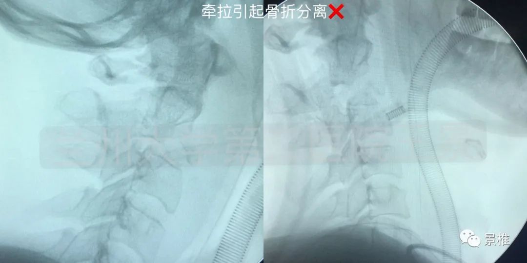 Hangman骨折前路术式教程，15张高清操作图示速学！