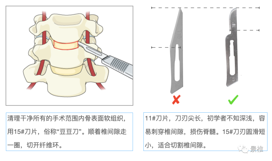 Hangman骨折前路术式教程，15张高清操作图示速学！