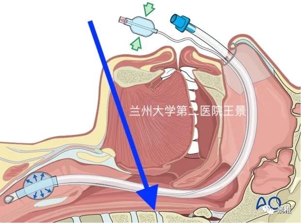 Hangman骨折前路术式教程，15张高清操作图示速学！