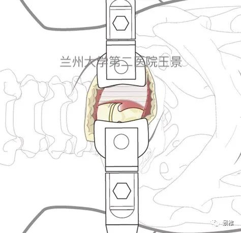 Hangman骨折前路术式教程，15张高清操作图示速学！