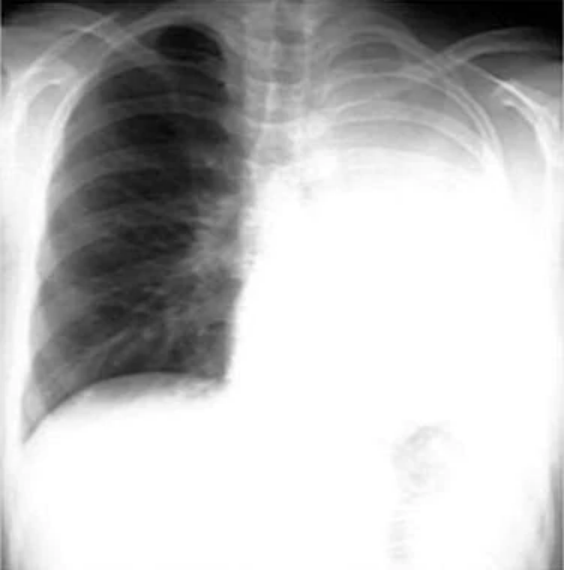 世界无烟日：触目惊心！浓烟下的肺原来长这样！